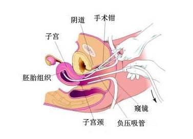 终止妊娠那些事，你知道多少？