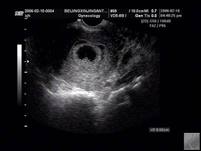 怀孕10周b超图